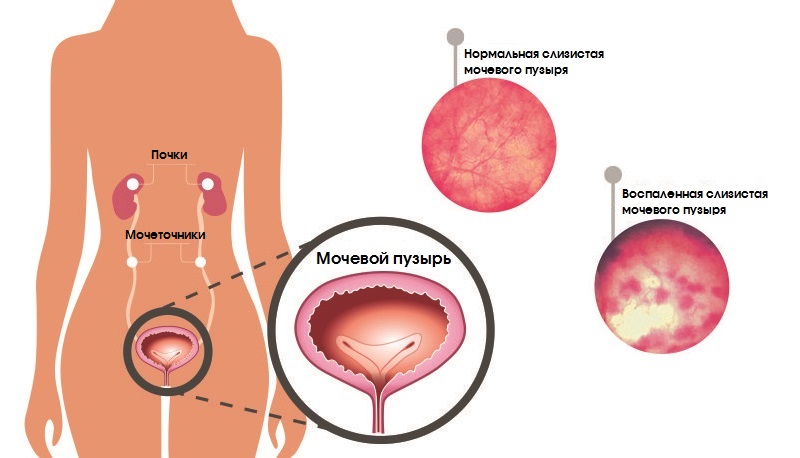 Воспаление мочевого пузыря у мужчин: лечение цистита острого и хронического