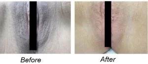 Vaginal-Bleach-Before-and-After